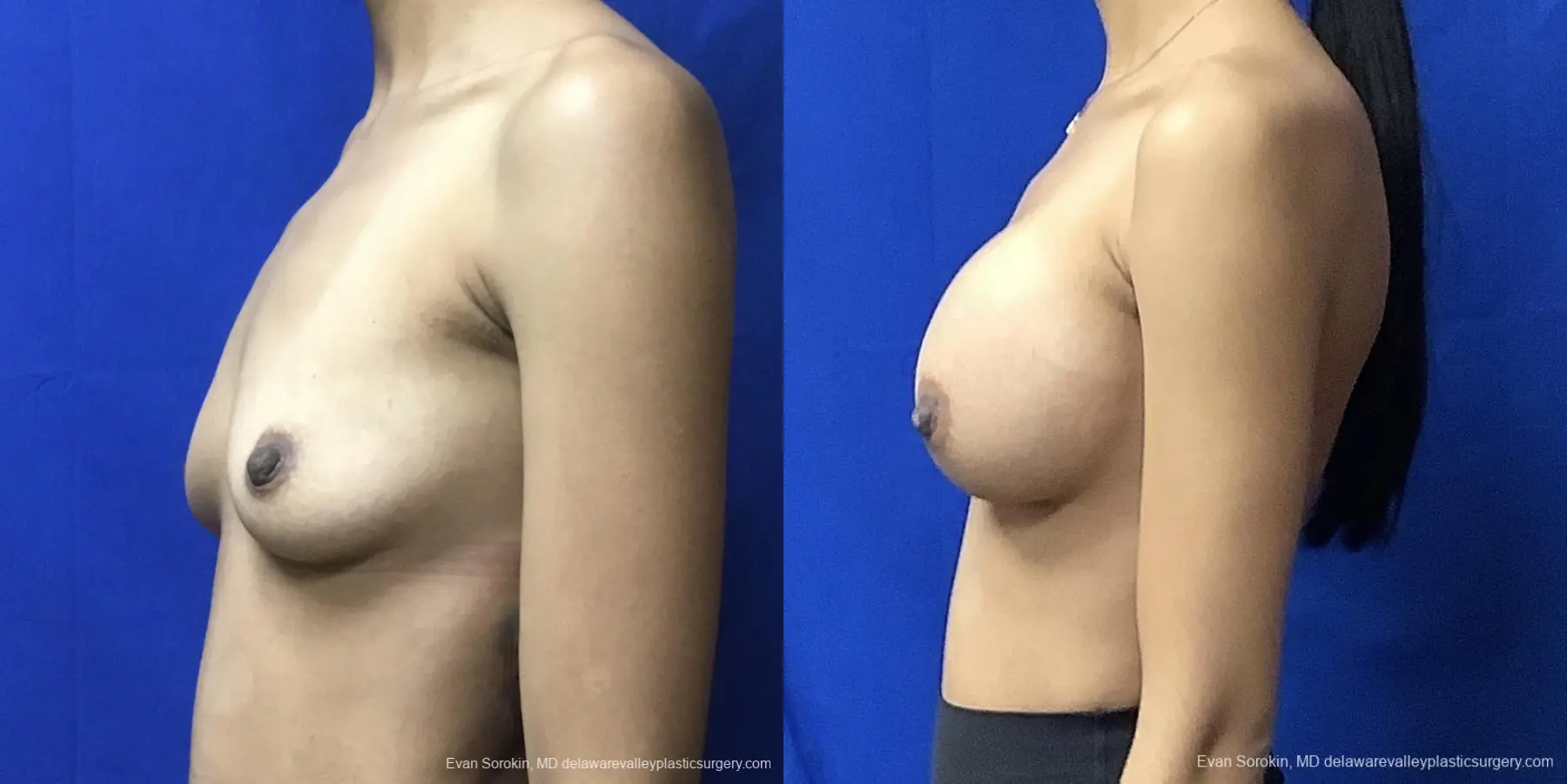 Breast Augmentation: Patient 220 - Before and After 4