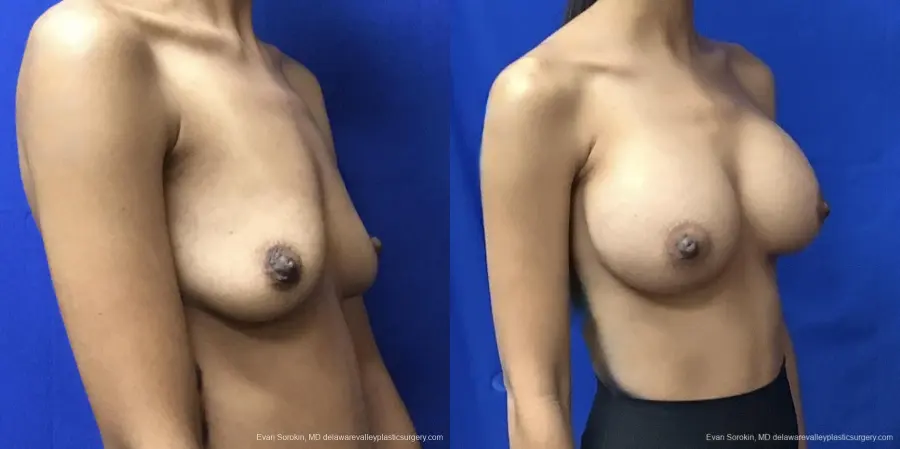 Breast Augmentation: Patient 191 - Before and After 2