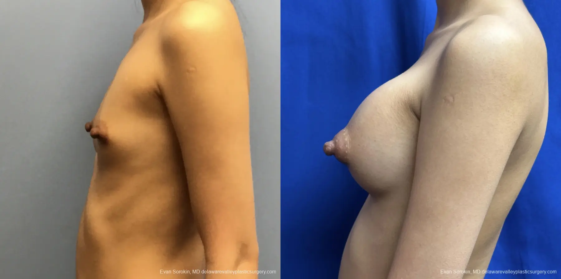Breast Augmentation: Patient 251 - Before and After 5