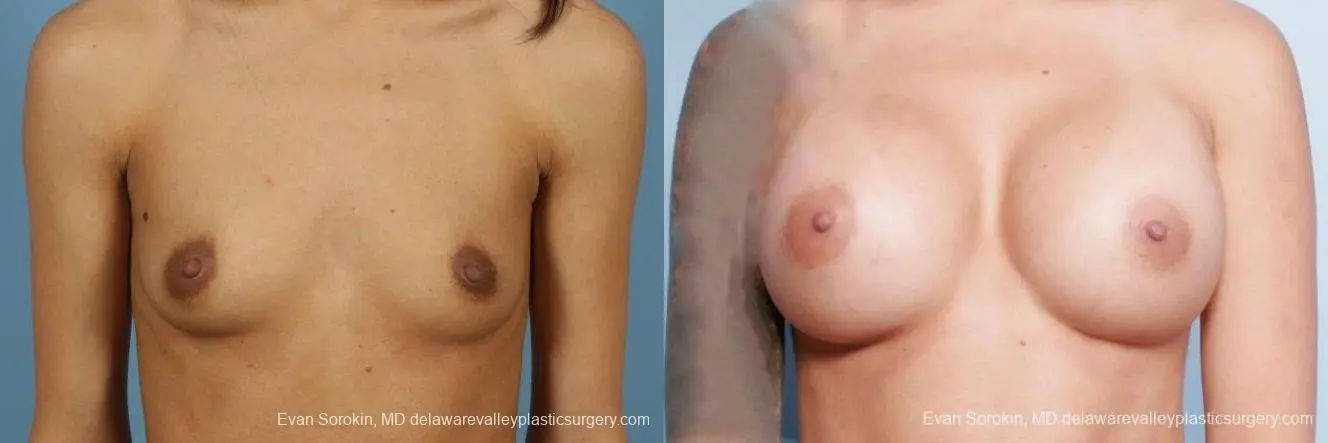 Philadelphia Breast Augmentation 9411 - Before and After 1