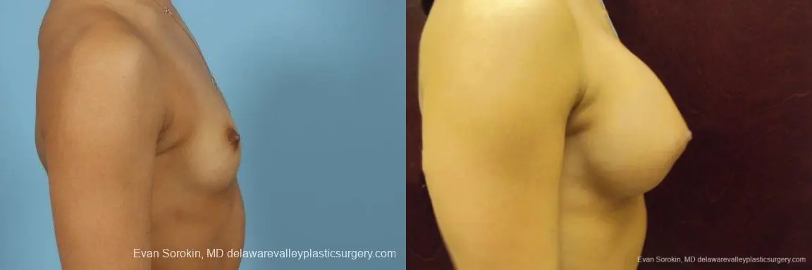 Philadelphia Breast Augmentation 9408 - Before and After 3