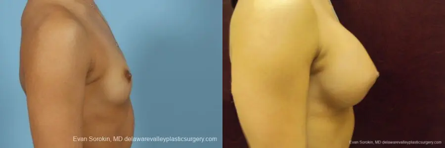 Philadelphia Breast Augmentation 9408 - Before and After 3