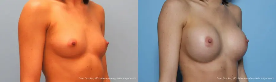 Philadelphia Breast Augmentation 9421 - Before and After 2