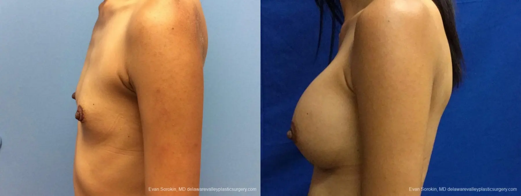 Philadelphia Breast Augmentation 13071 - Before and After 4