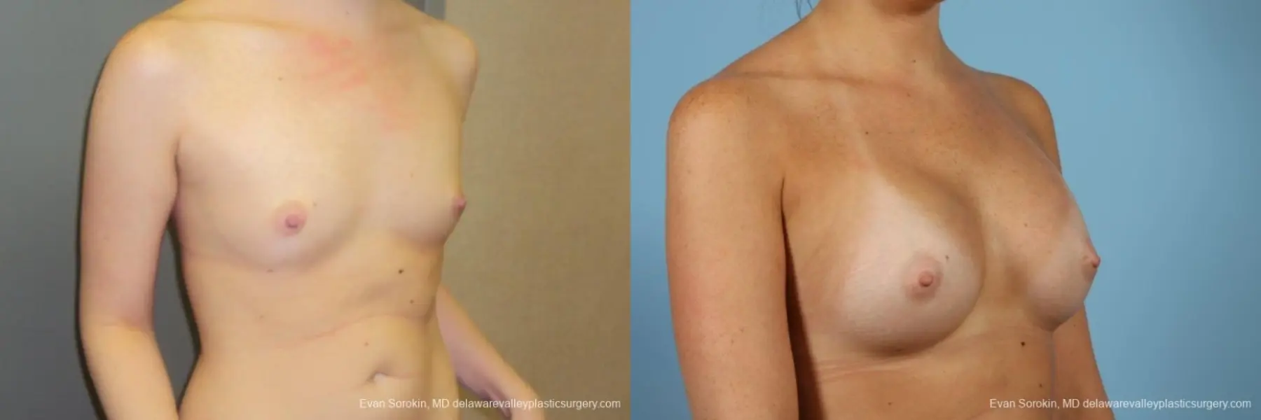 Philadelphia Breast Augmentation 8669 - Before and After 2