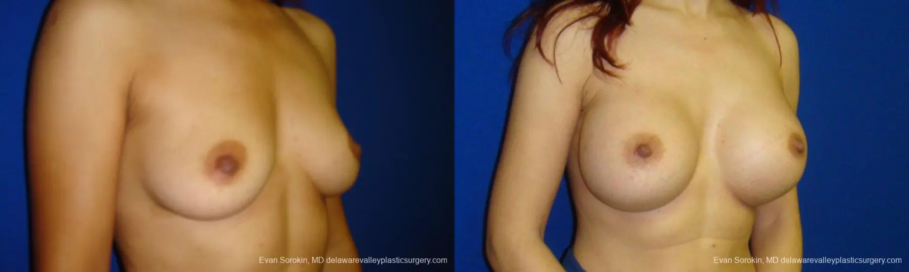 Philadelphia Breast Augmentation 9294 - Before and After 4