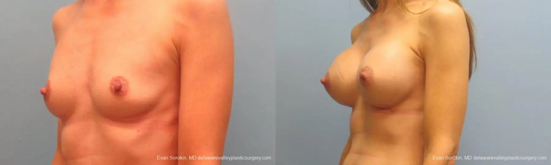 Philadelphia Breast Augmentation 9368 - Before and After 4