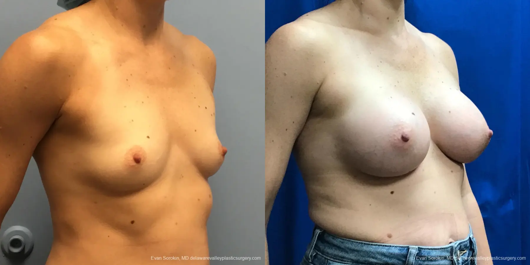 Breast Augmentation: Patient 183 - Before and After 2