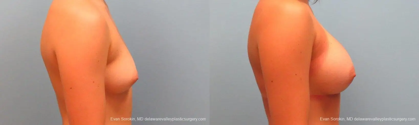 Philadelphia Breast Augmentation 9386 - Before and After 3