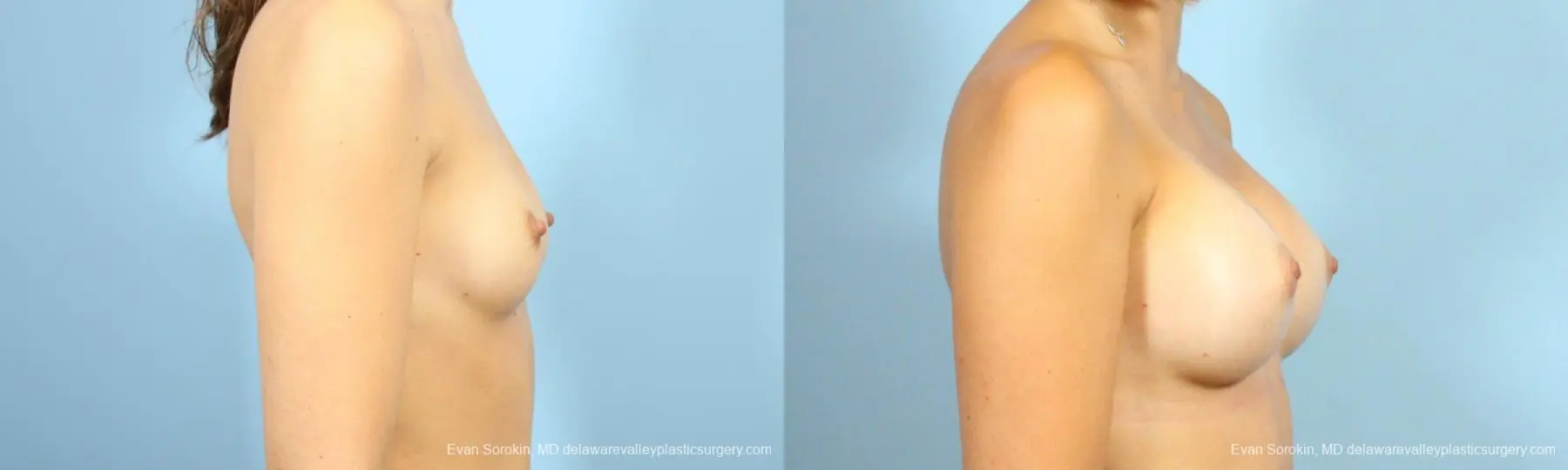 Philadelphia Breast Augmentation 8641 - Before and After 3
