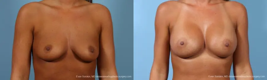 Philadelphia Breast Augmentation 9404 - Before and After 1