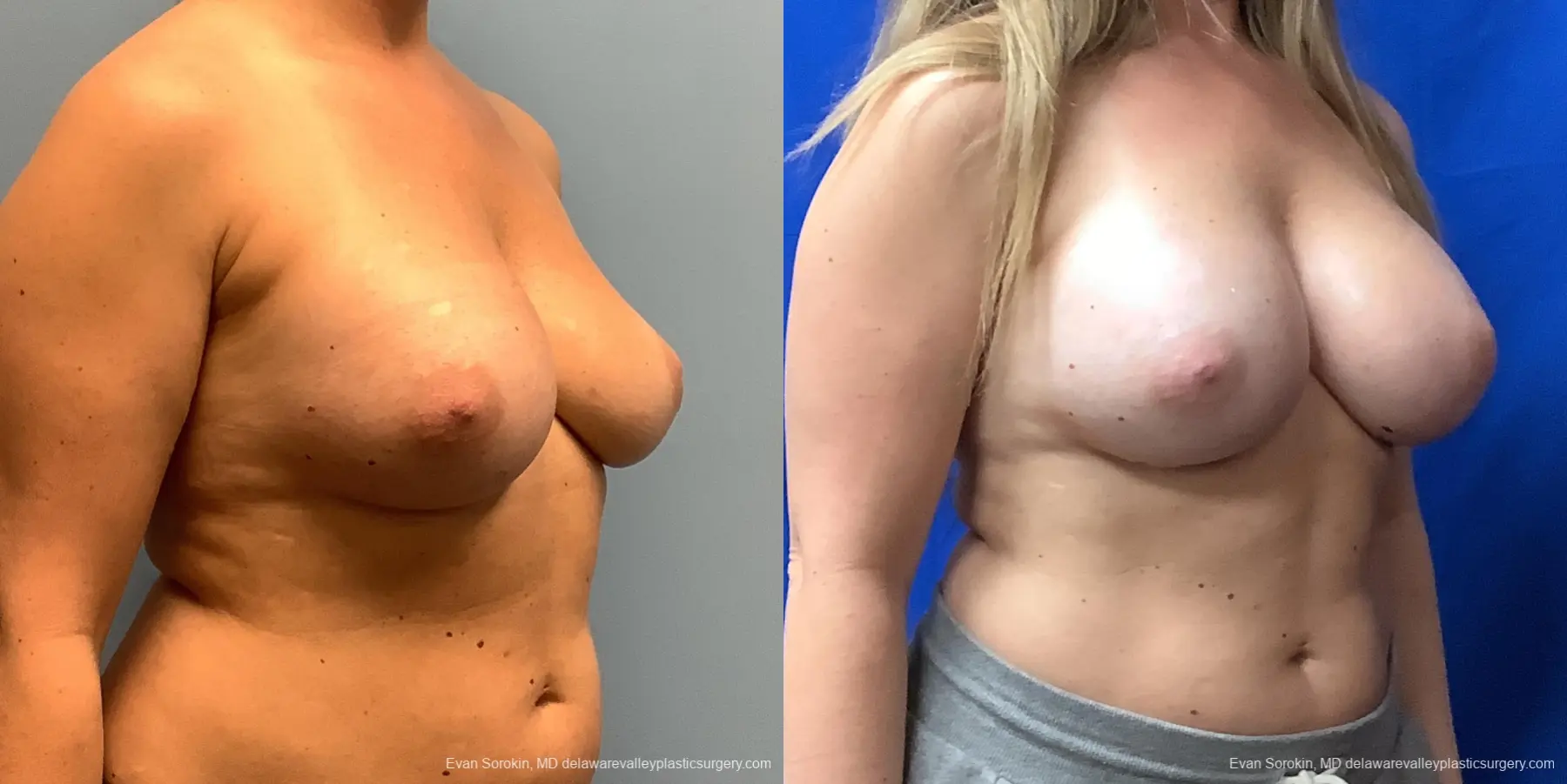 Breast Augmentation Revision: Patient 32 - Before and After 4