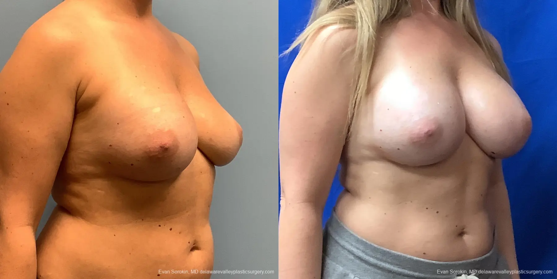 Breast Augmentation: Patient 229 - Before and After 4