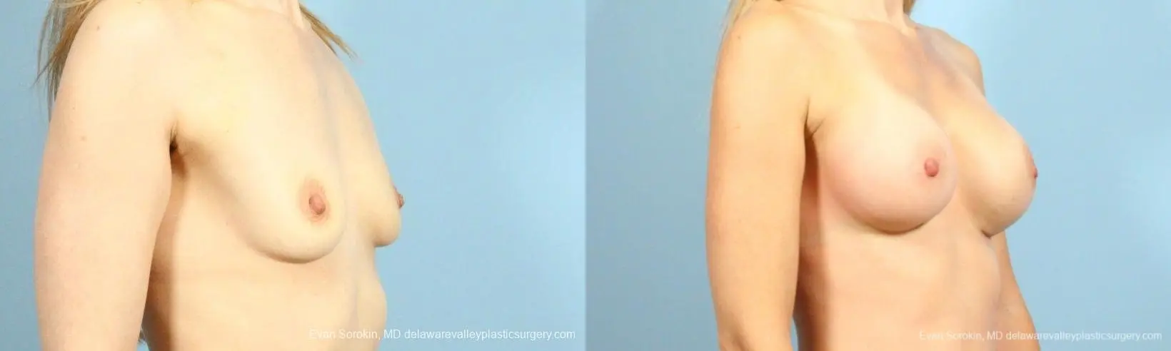 Philadelphia Breast Augmentation 8659 - Before and After 2