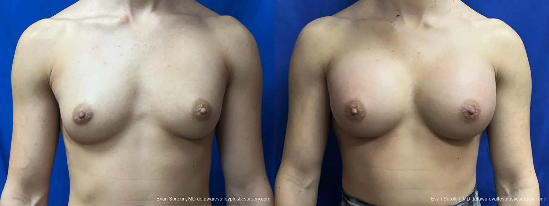 Breast Augmentation: Patient 202 - Before and After 1