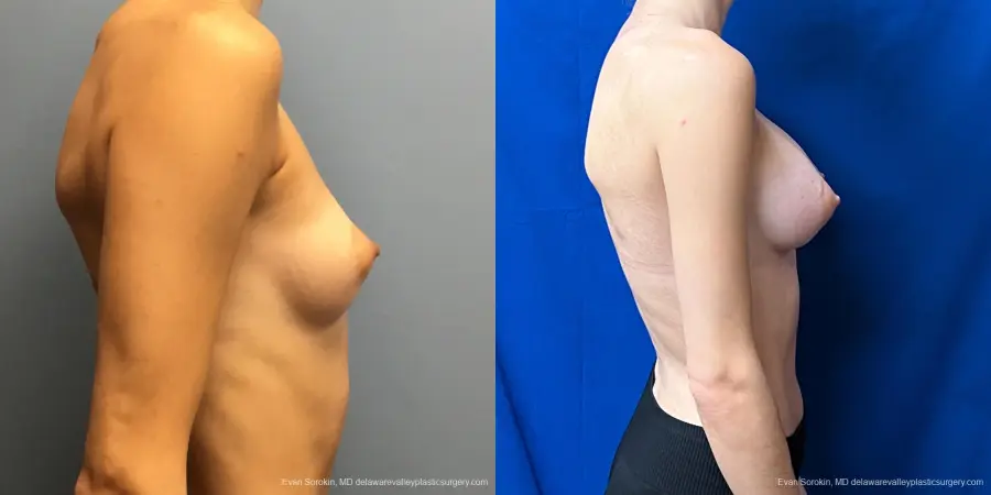 Breast Augmentation: Patient 226 - Before and After 4