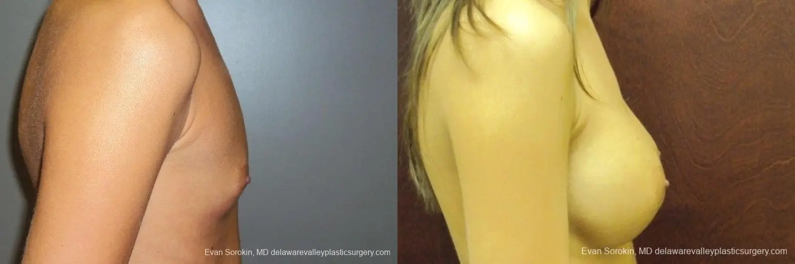 Philadelphia Breast Augmentation 8668 - Before and After 4