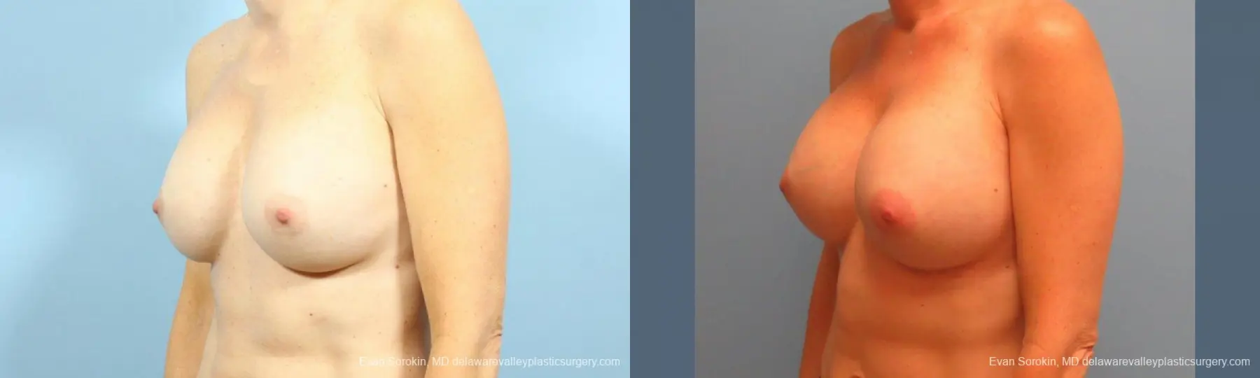 Philadelphia Breast Augmentation 9456 - Before and After 4