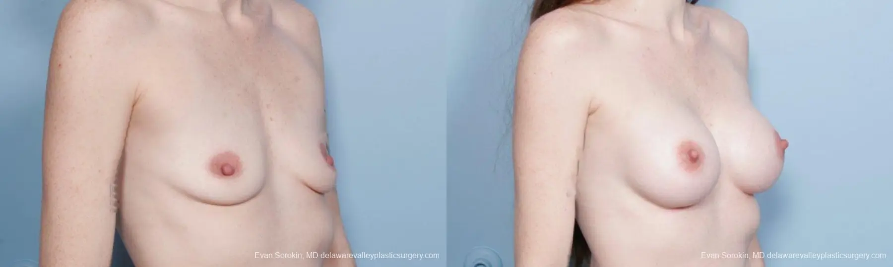 Philadelphia Breast Augmentation 8649 - Before and After 2