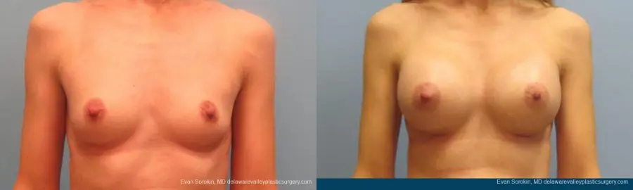 Philadelphia Breast Augmentation 9368 - Before and After 1