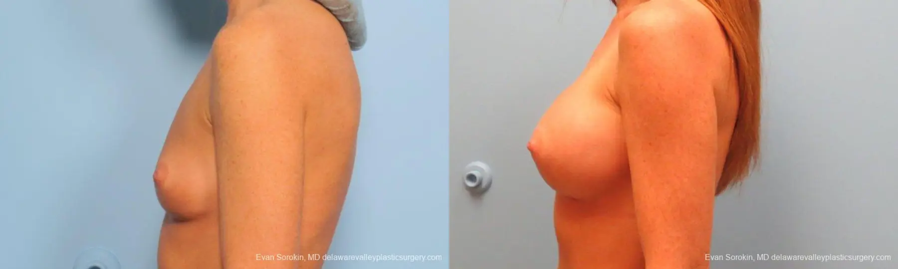 Philadelphia Breast Augmentation 9179 - Before and After 5