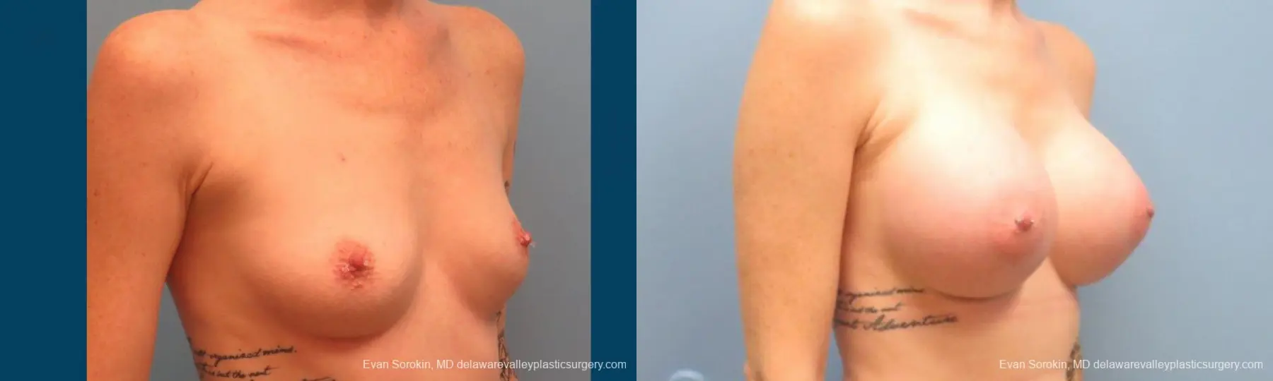 Philadelphia Breast Augmentation 9371 - Before and After 2