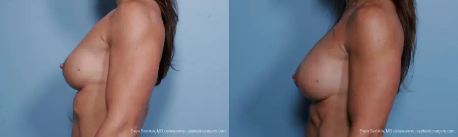 Philadelphia Breast Augmentation 9455 - Before and After 5