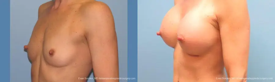 Philadelphia Breast Augmentation 9744 - Before and After 4