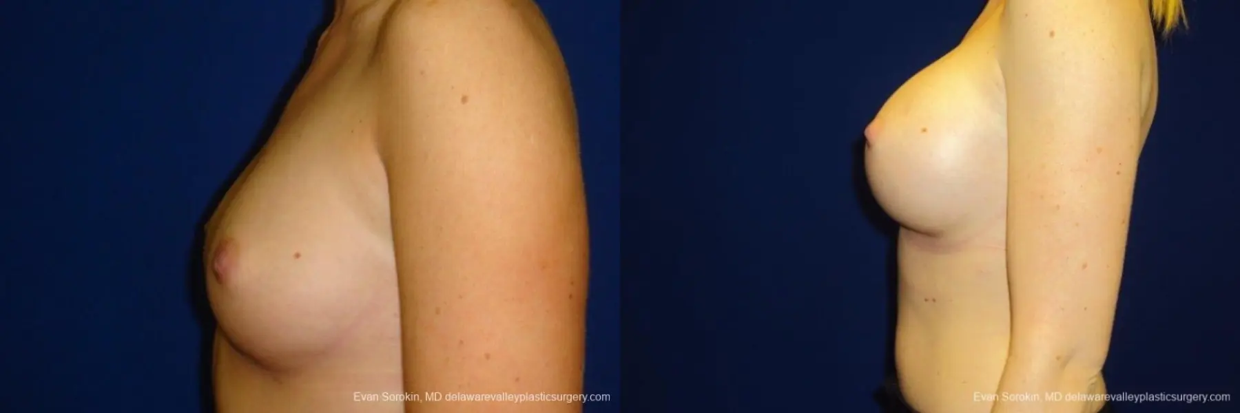 Philadelphia Breast Augmentation 8670 - Before and After 5