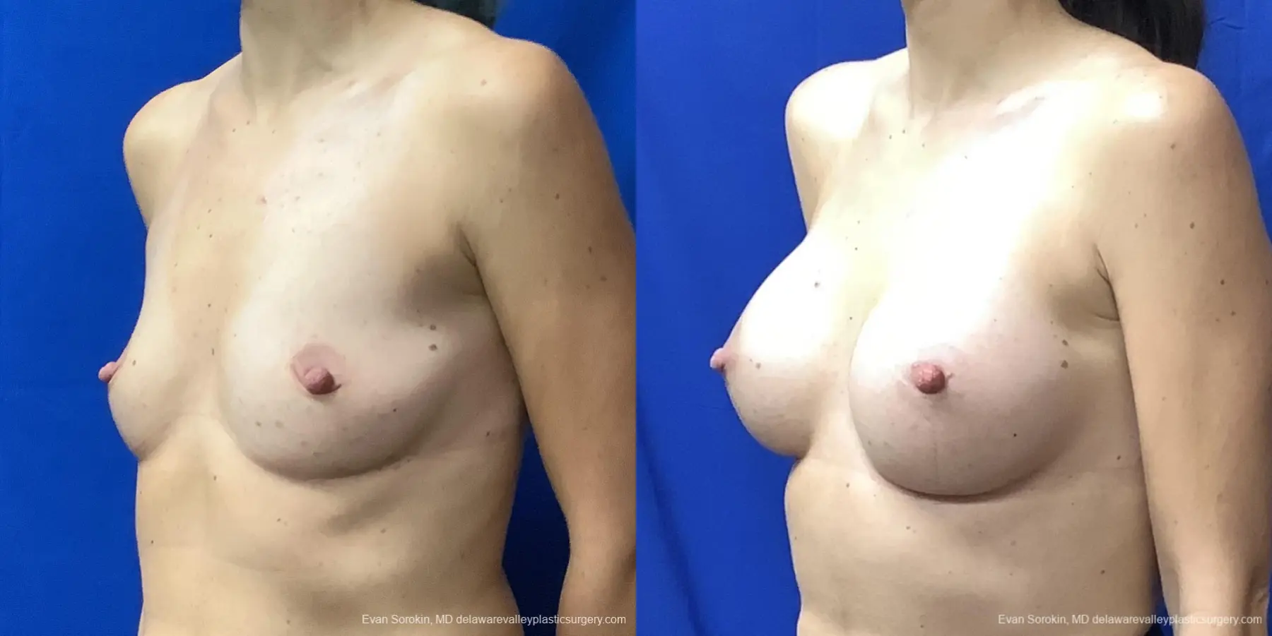 Breast Augmentation: Patient 226 - Before and After 4