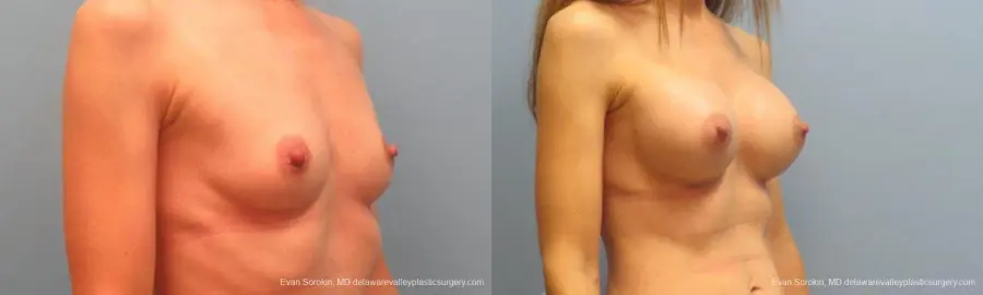 Philadelphia Breast Augmentation 9368 - Before and After 2