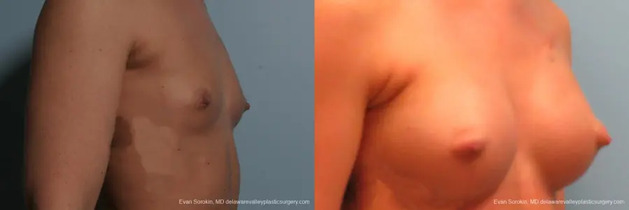 Philadelphia Breast Augmentation 8664 - Before and After 2