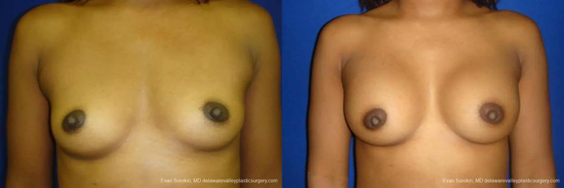 Philadelphia Breast Augmentation 8665 - Before and After