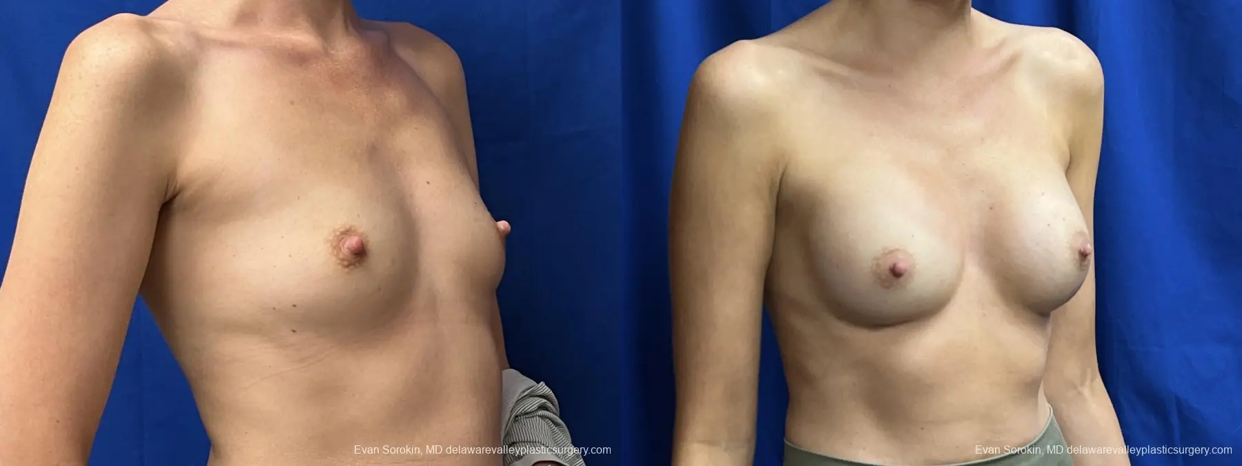 Breast Augmentation: Patient 205 - Before and After 2