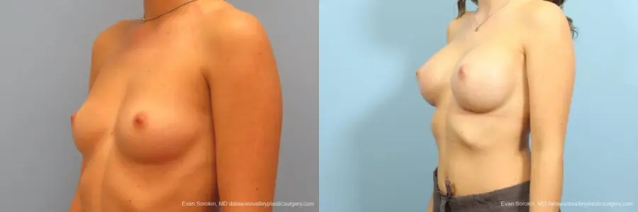 Philadelphia Breast Augmentation 8666 - Before and After 3