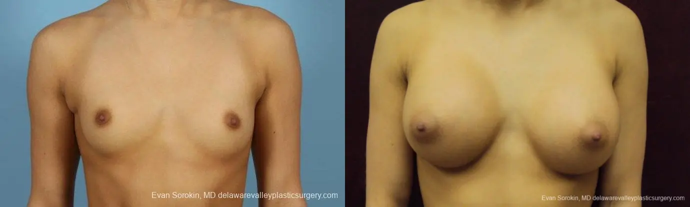 Philadelphia Breast Augmentation 9408 - Before and After 1