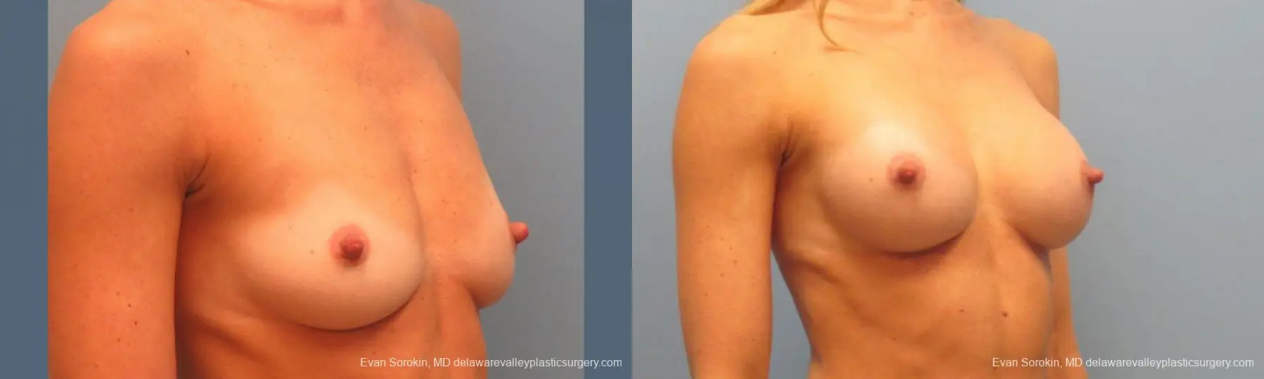 Philadelphia Breast Augmentation 9397 - Before and After 2