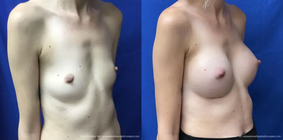 Breast Augmentation: Patient 174 - Before and After 2