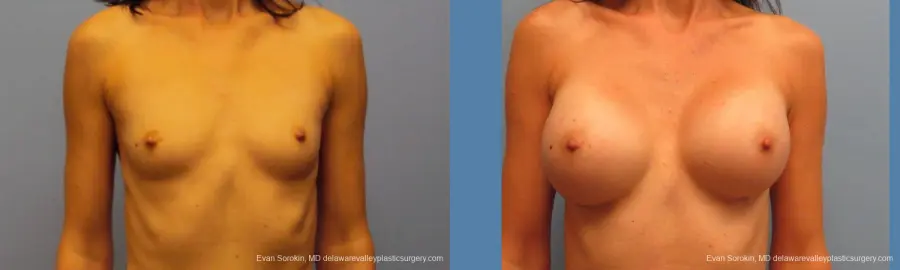 Philadelphia Breast Augmentation 9417 - Before and After 1