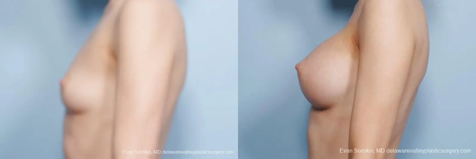 Philadelphia Breast Augmentation 8663 - Before and After 5