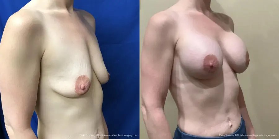 Breast Augmentation: Patient 188 - Before and After 2