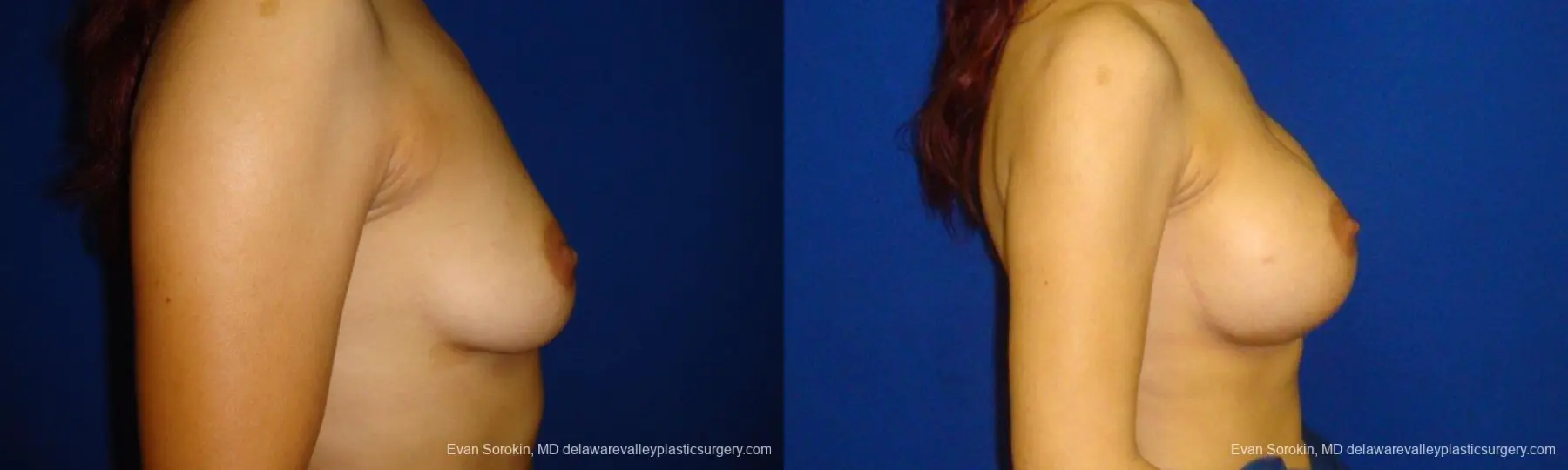 Philadelphia Breast Augmentation 9294 - Before and After 5