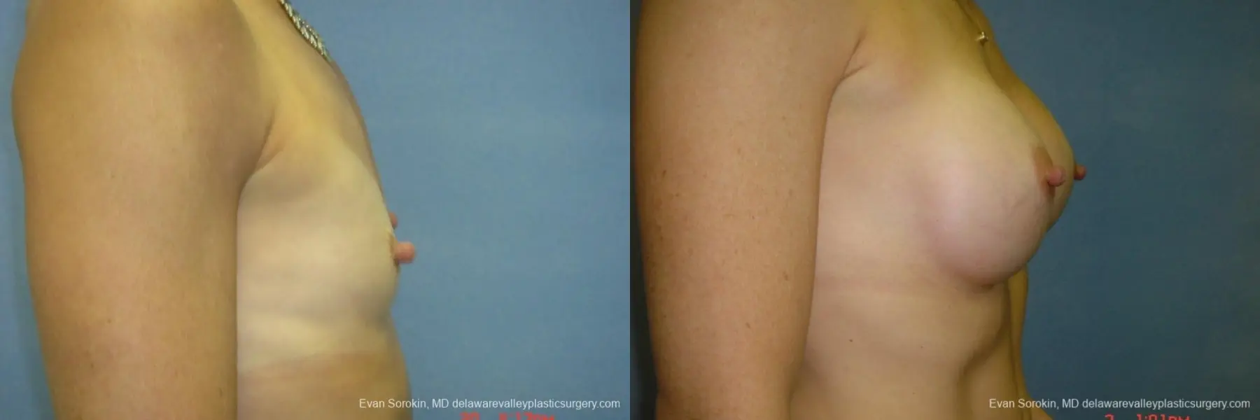 Breast Augmentation 8667 - Before and After 3