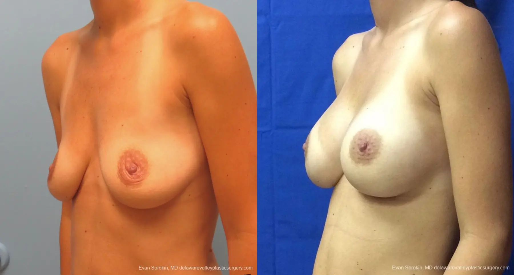 Philadelphia Breast Augmentation 13067 - Before and After 4