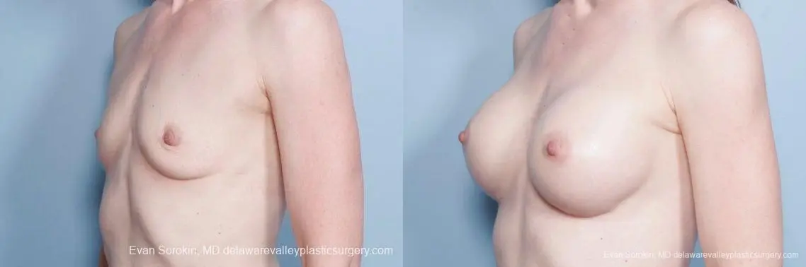 Philadelphia Breast Augmentation 9169 - Before and After 4