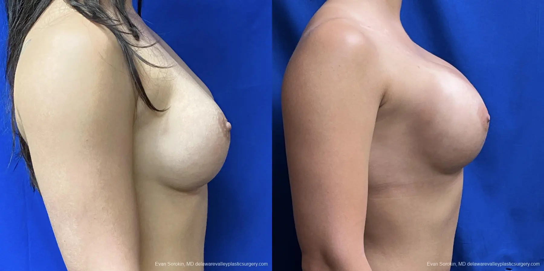 Breast Augmentation: Patient 250 - Before and After 3