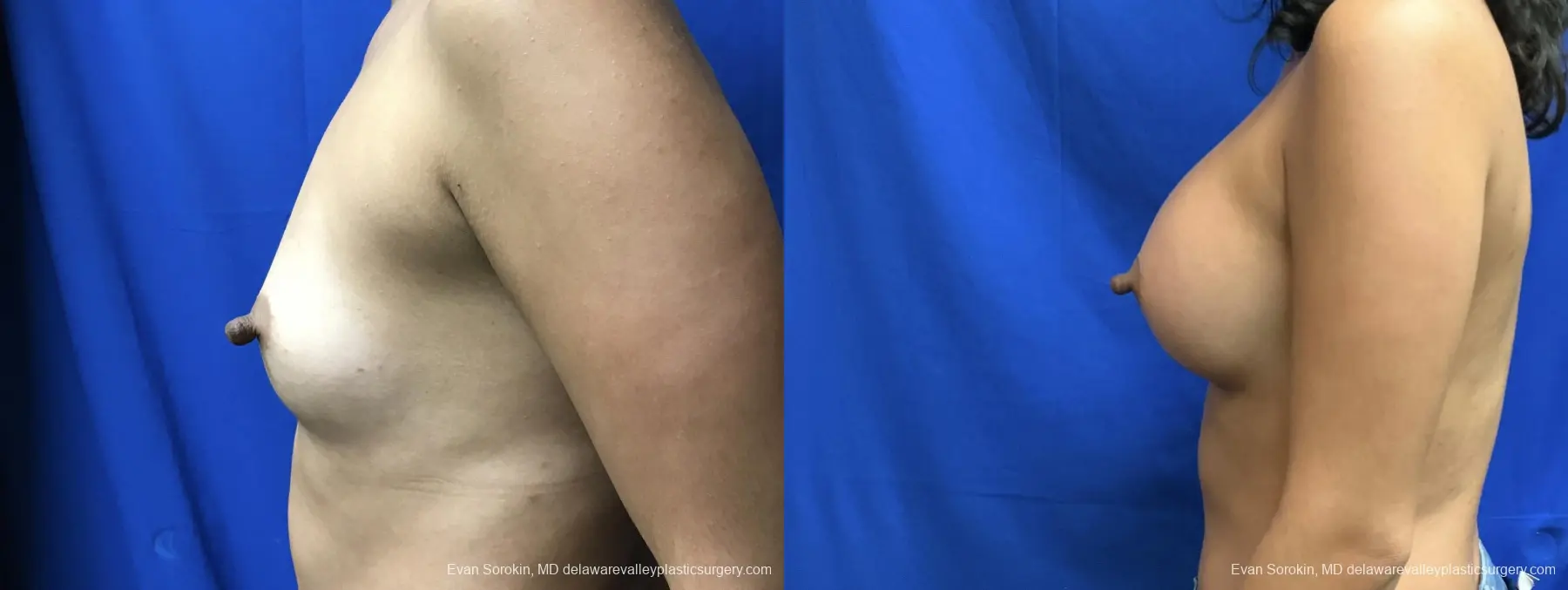 Breast Augmentation: Patient 210 - Before and After 5