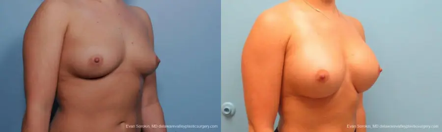 Philadelphia Breast Augmentation 9383 - Before and After 2
