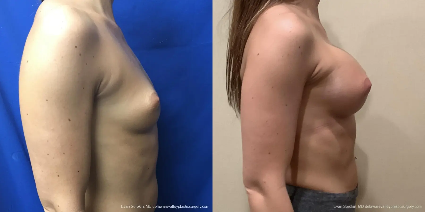 Breast Augmentation: Patient 186 - Before and After 3