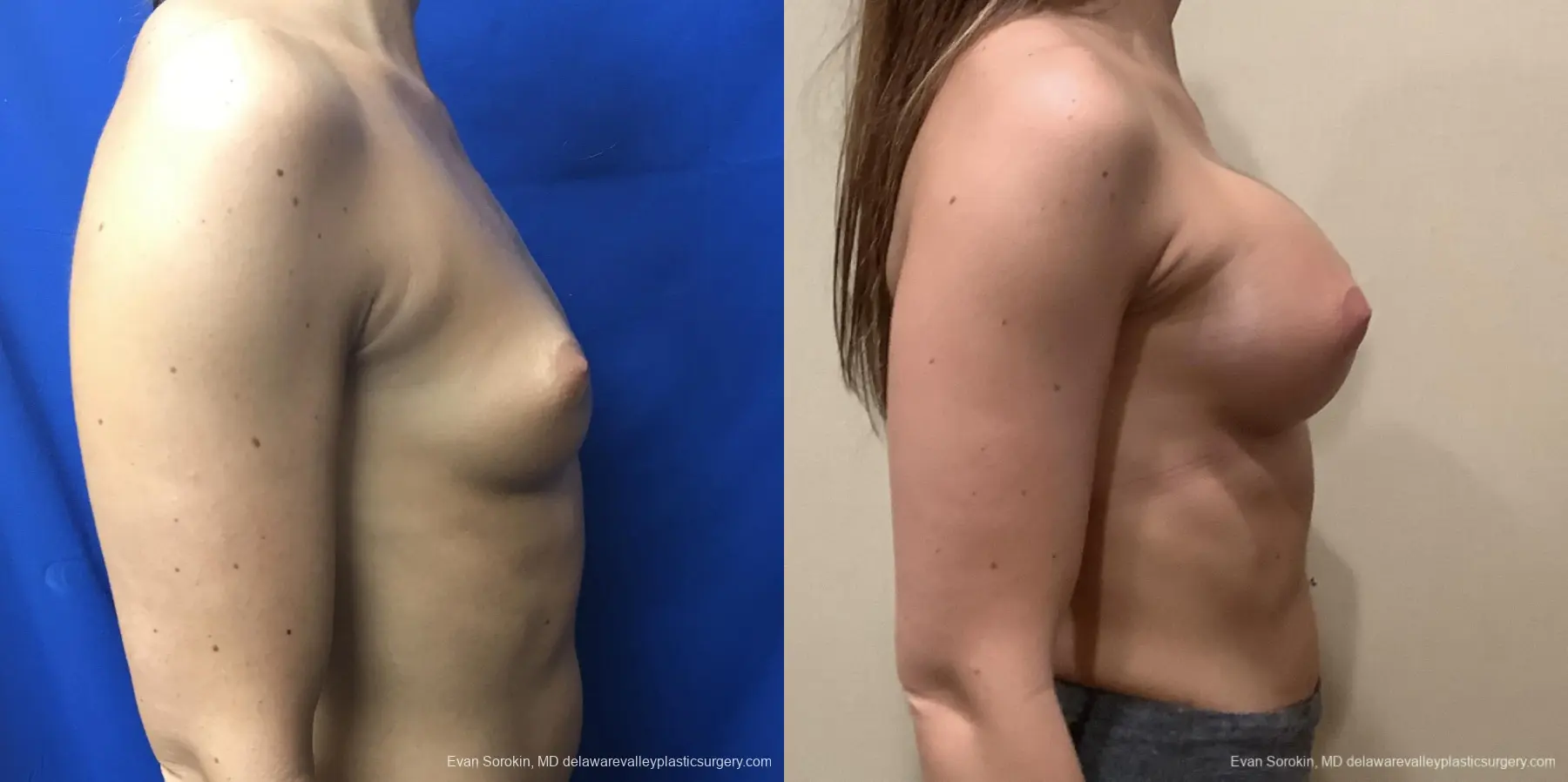 Breast Augmentation: Patient 219 - Before and After 3